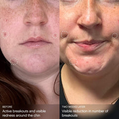 Clearly Clarifying & Calming Mask For Acne-Prone Skin