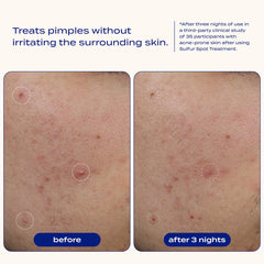Sulfur Spot Treatment for Acne and Blemishes