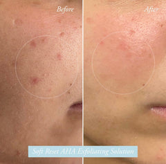 Soft Reset AHA Exfoliating Solution